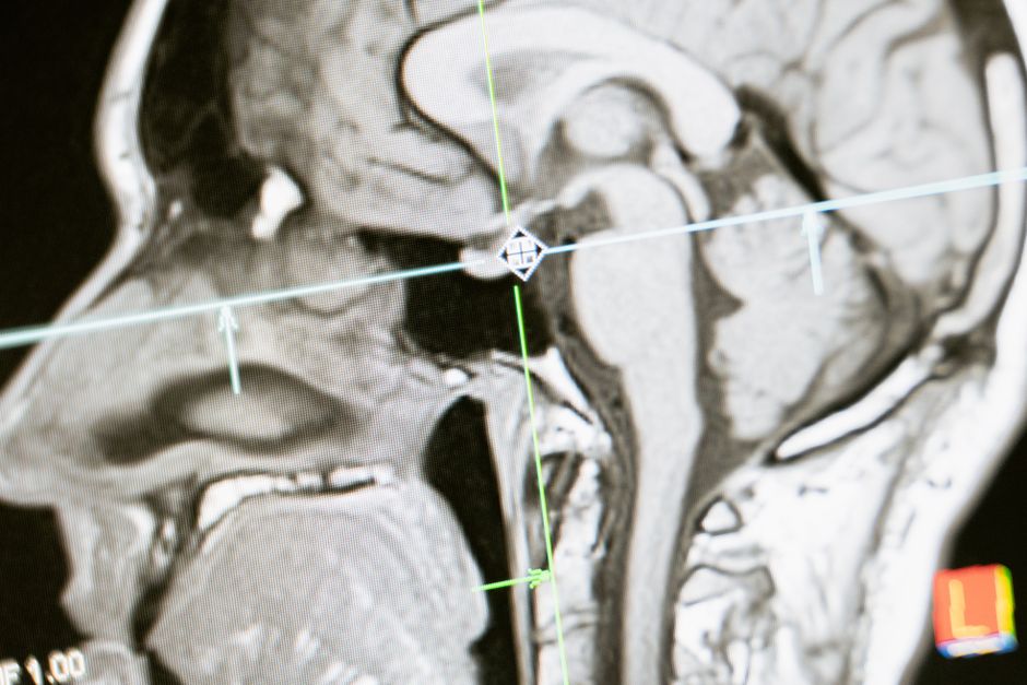Illustration related to brain anatomy